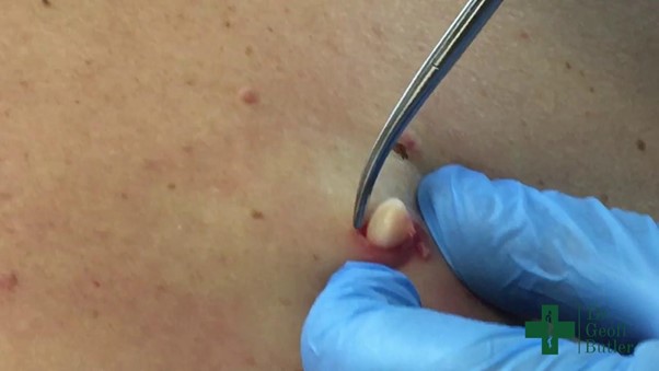 Cyst Removal Surgery A Comprehensive Guide