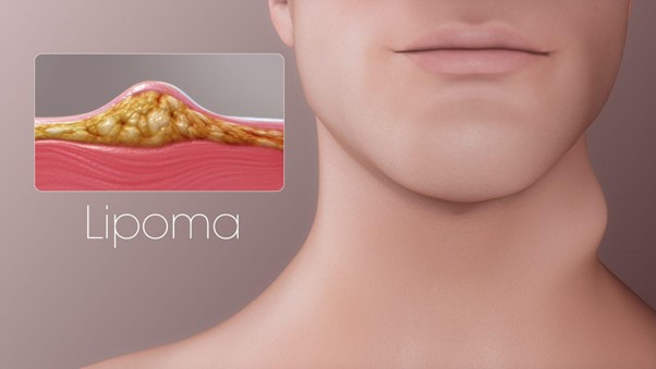 Guide to Lipoma Removal Surgery and Treatment